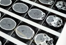 Imágenes del cerebro y la mala salud metabólica