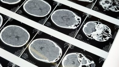 Imágenes del cerebro y la mala salud metabólica