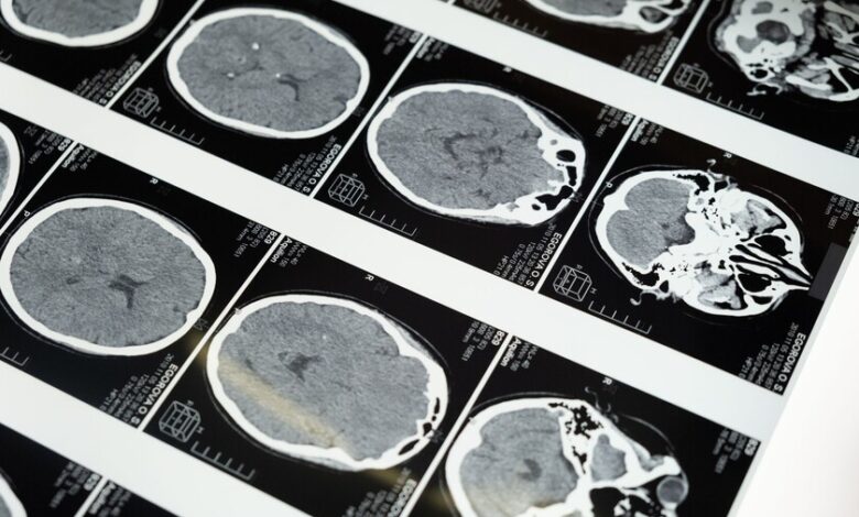 Imágenes del cerebro y la mala salud metabólica