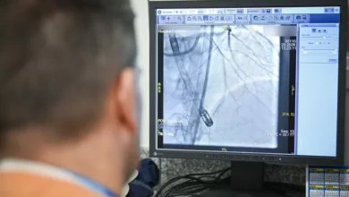 Equipo médico realizando una angioplastia coronaria con soporte mecánico